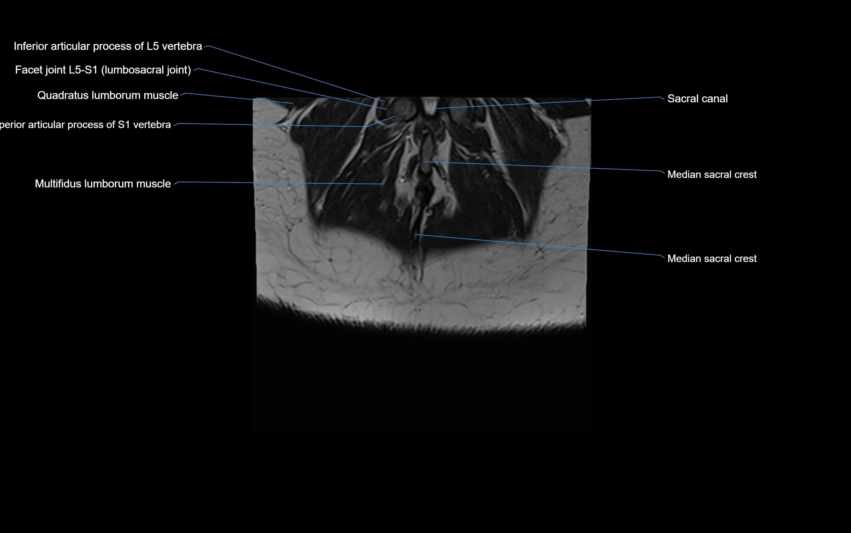 MRI sacroiliac joint coronal cross sectional anatomy  radiology  image-img-00001-00031.webp